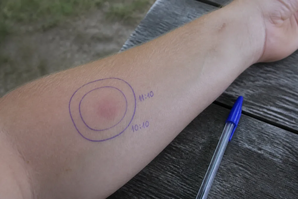 A forearm with a small reddened lesion outlined twice in ballpoint pen with different times written beside each outline, showing whether the redness has spread between them | KnowOutdoor